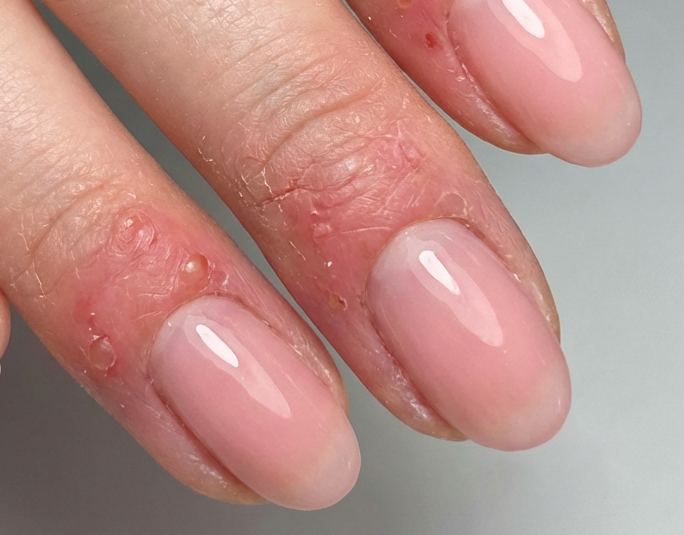 Allergie gegen Gel?